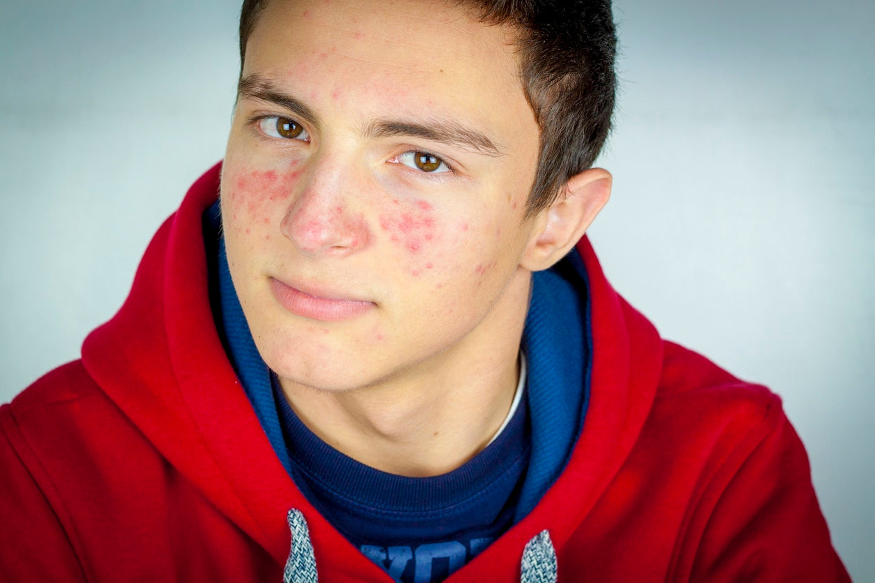 Discover the Best Acne Treatments for Teens - ClearB5