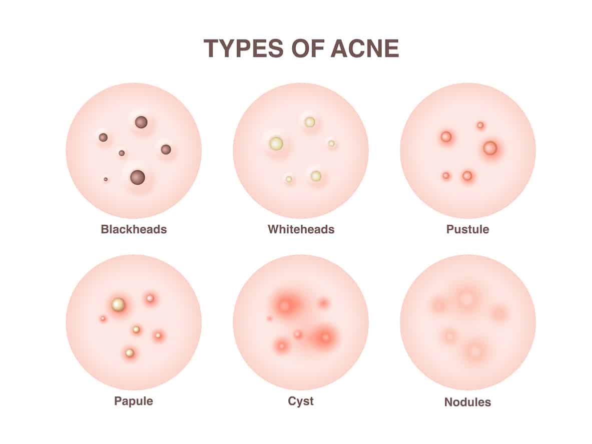 Understanding the Different Types of Acne - ClearB5