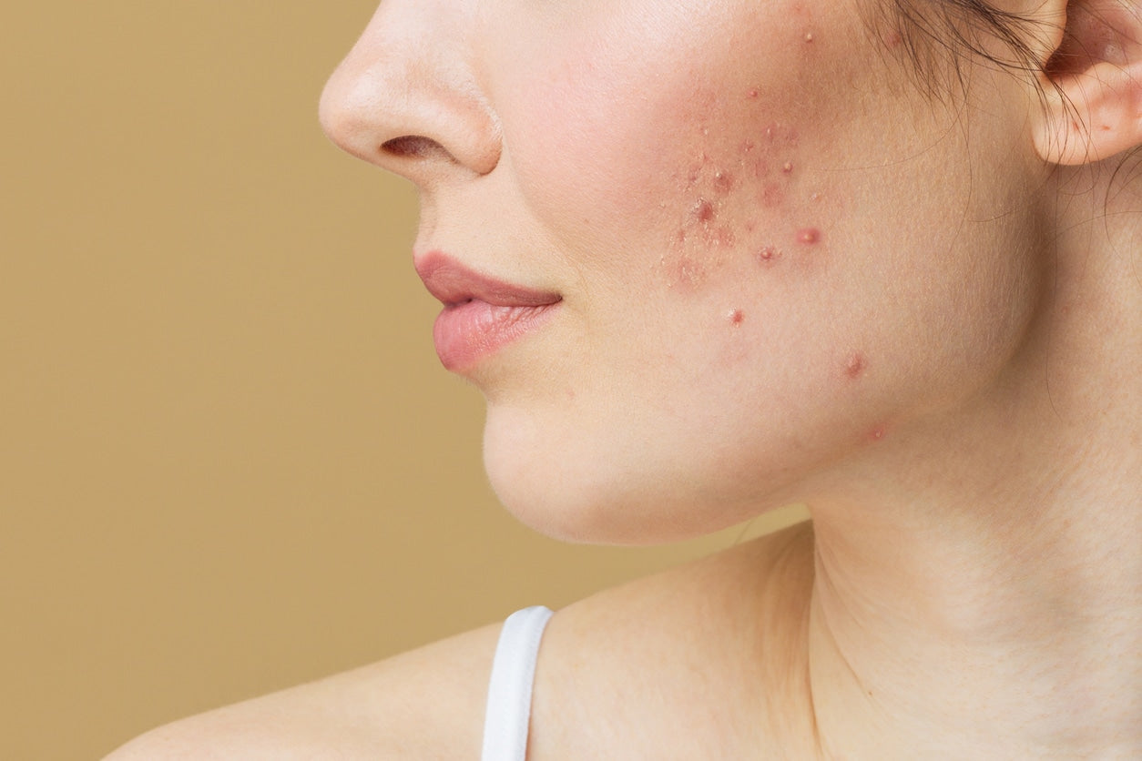 What is Hormonal Acne? - ClearB5