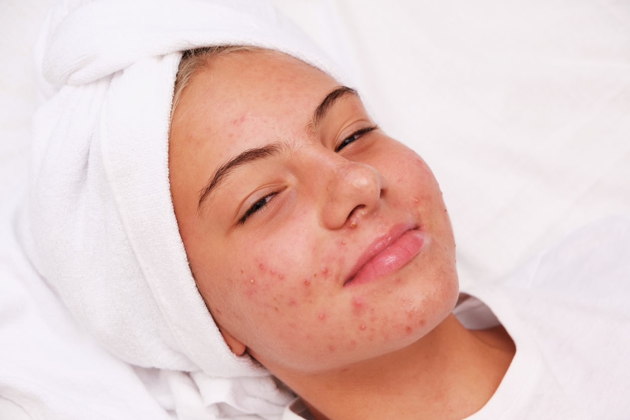 best acne treatments