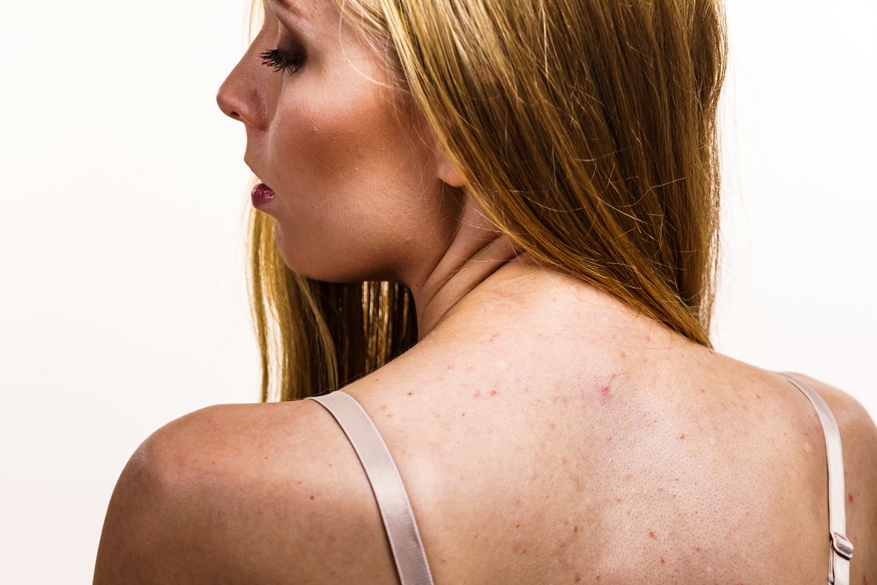 best treatment for back acne