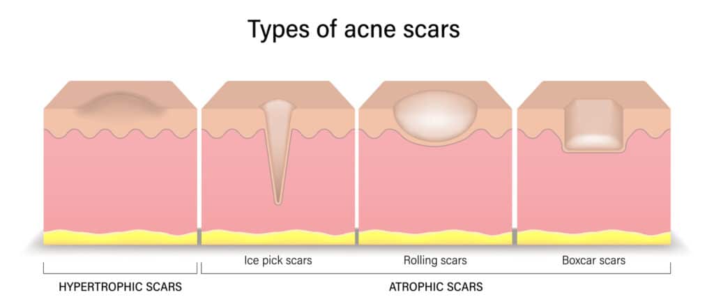 Acne Scar Treatment Options - ClearB5