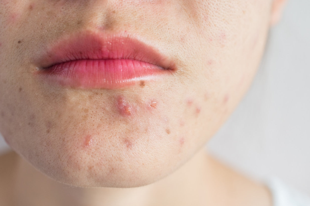 Acne vs Pimples – How To Spot the Difference - ClearB5