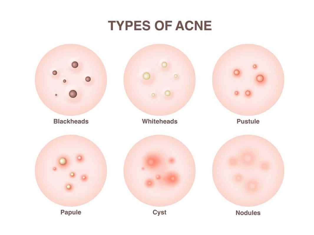 Understanding the Different Types of Acne - ClearB5