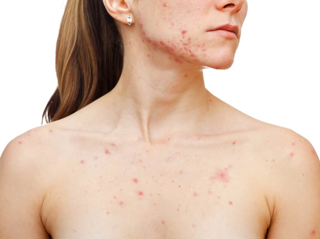 How to Get Rid of Chest Acne? - ClearB5