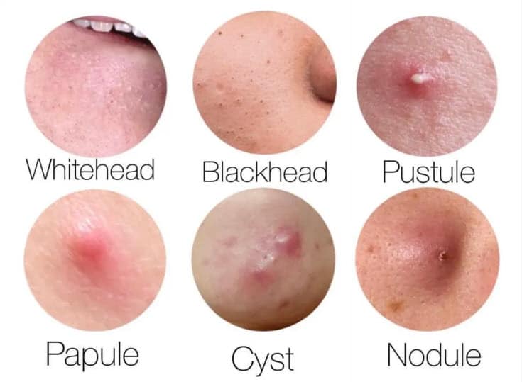 Understanding Types of Acne - ClearB5