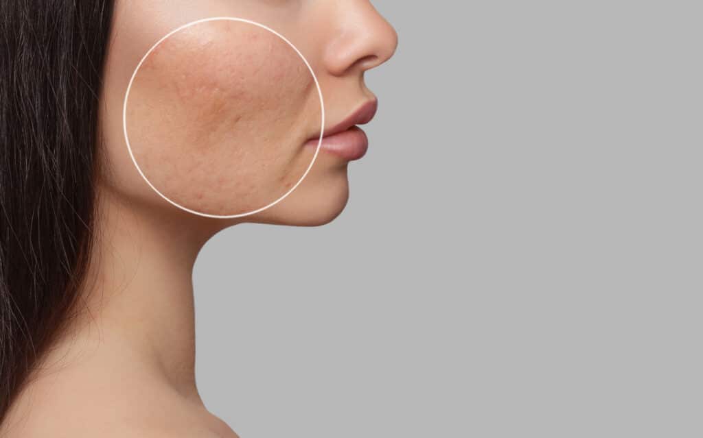 What is Fungal Acne? - ClearB5