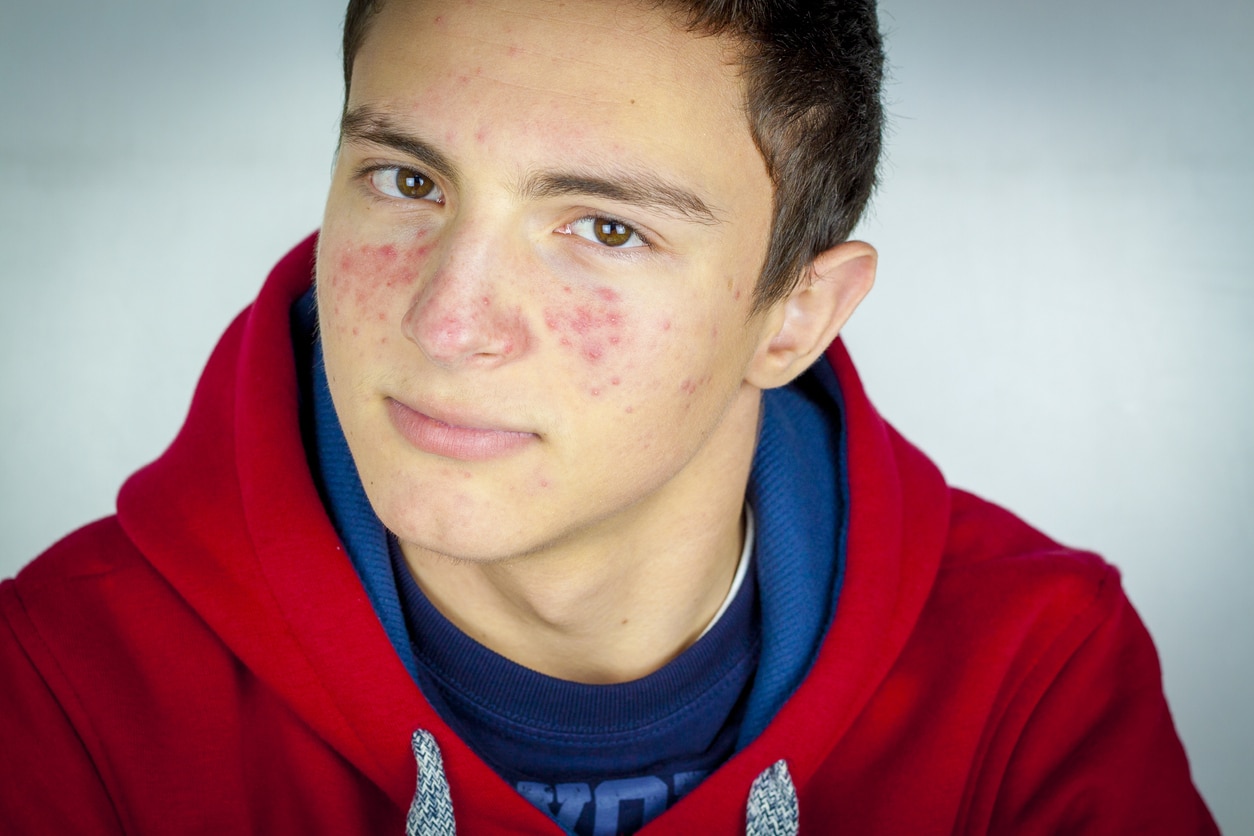 best acne treatments for teens