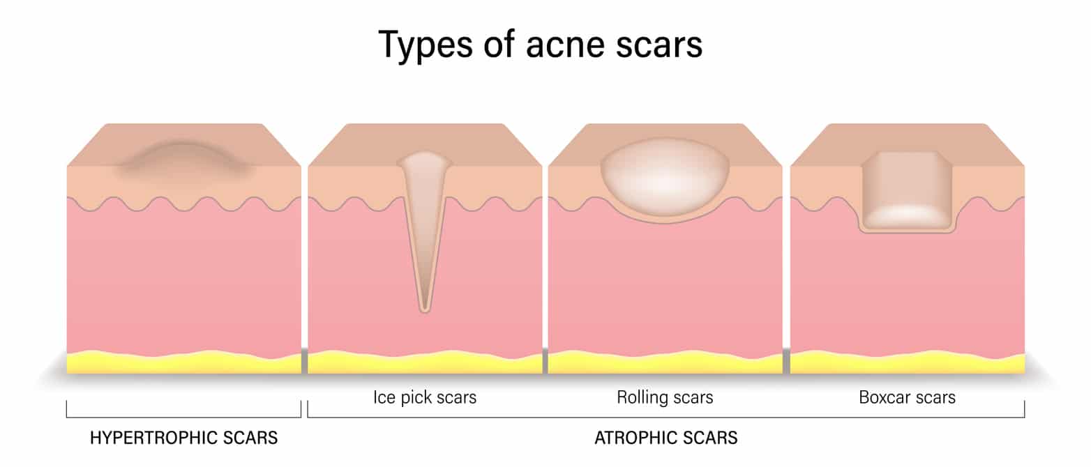 acne scar treatment