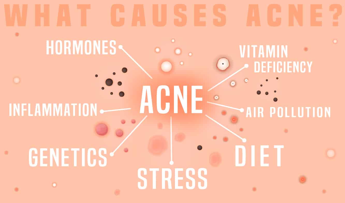 what causes acne