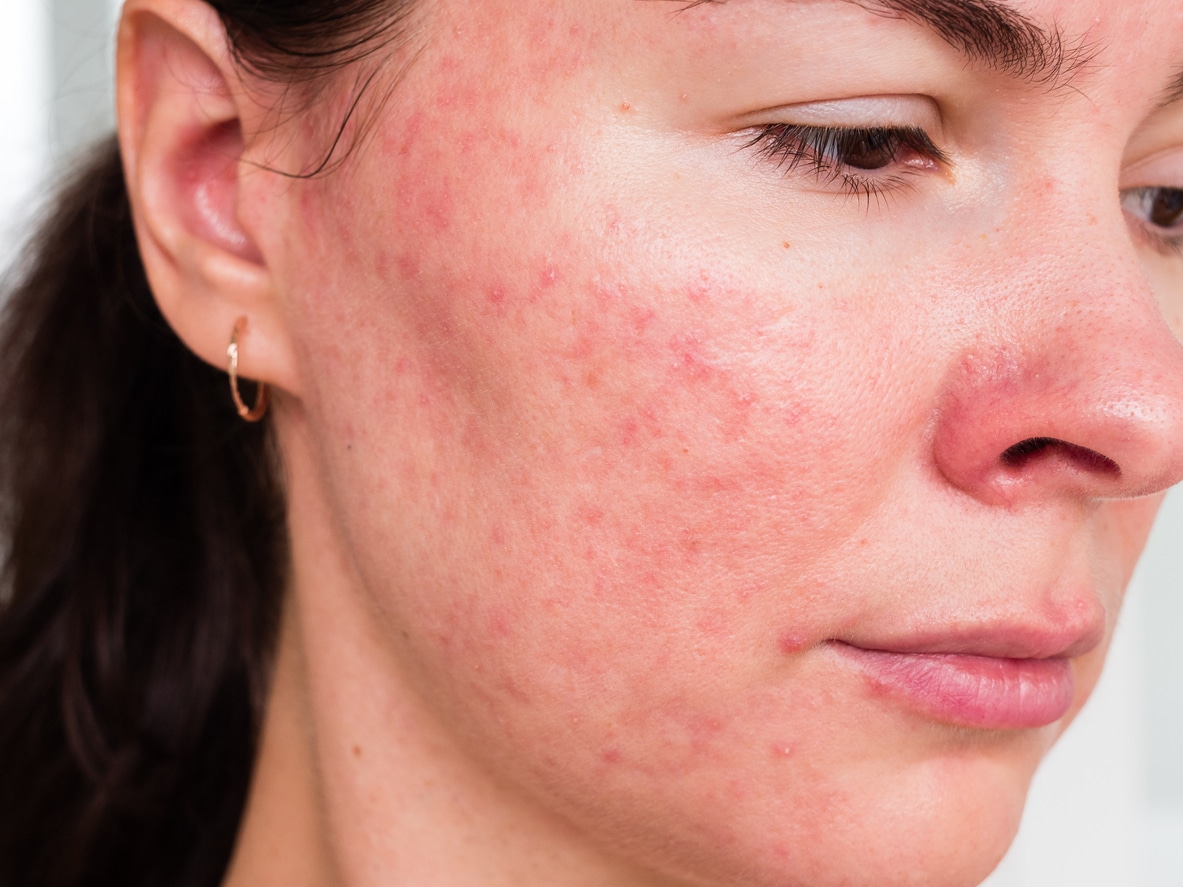 what is cystic acne