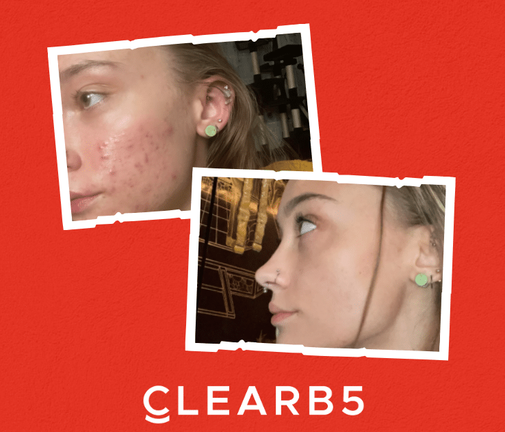 ClearB5 positive results testimonial